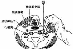 星状神经节阻滞(stellate ganglion block)  星状神经节由下颈交感